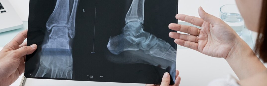 Peran Rontgen dalam Menilai Cedera Sendi dan Ligamen